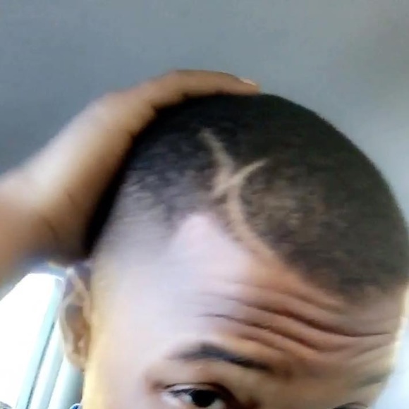 bruiseyatonsils